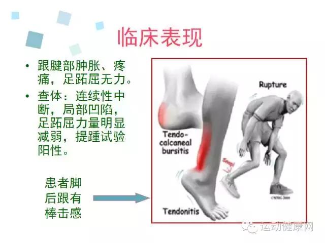 跟腱是人体最长,最强壮的肌腱,由小腿三头肌,即腓肠肌和比目鱼肌组成