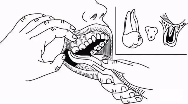 拔牙钳的正确使用方法