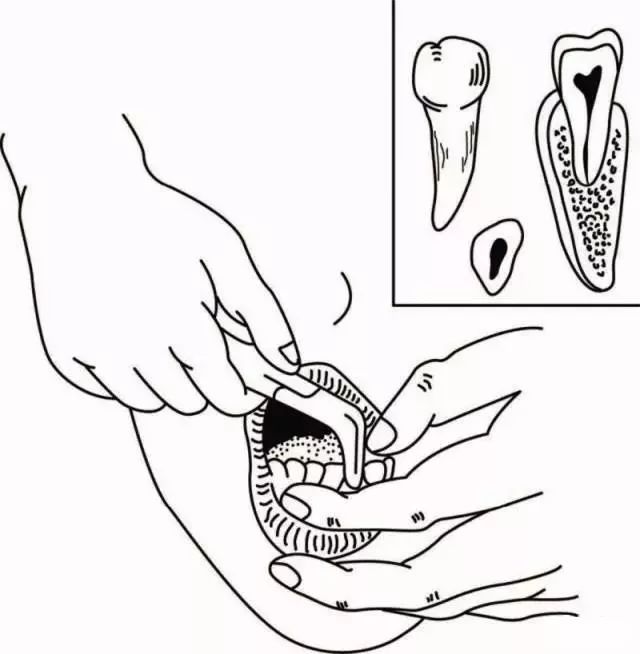 拔牙钳的正确使用方法