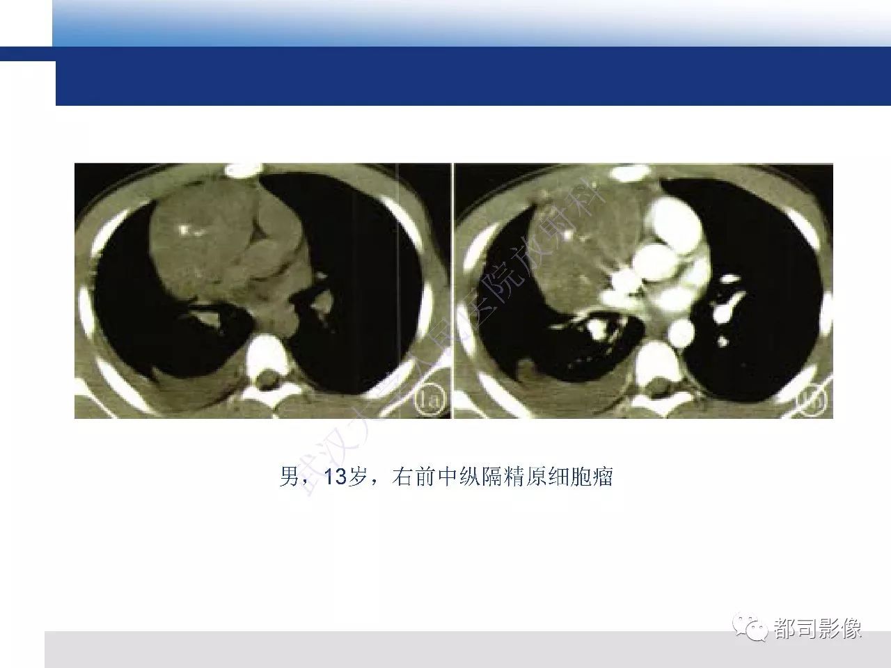 纵隔原发性生殖细胞肿瘤影像诊断