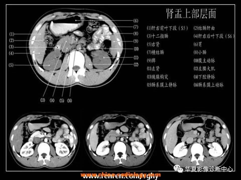 肾盂上部层面十二指肠水平段层面胰腺钩突层面胆囊体部层面胰体下部