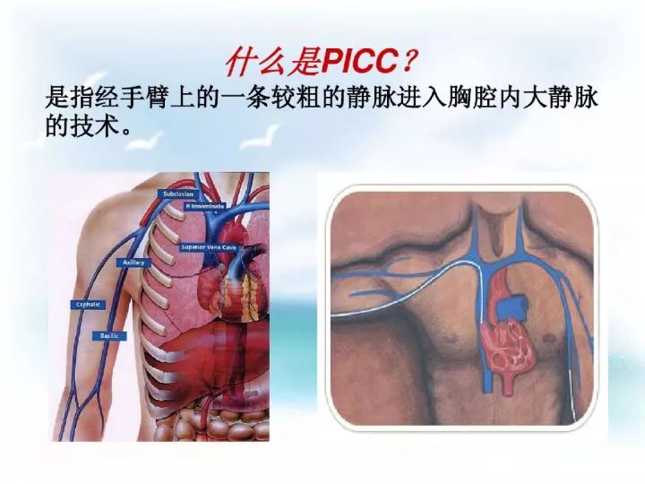 picc导管健康宣教