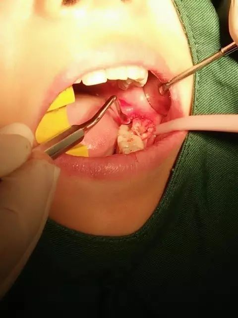 用到4号牙挺,避免敲击拔牙根,稍有不慎,可能会出现牙根移位下颌神经
