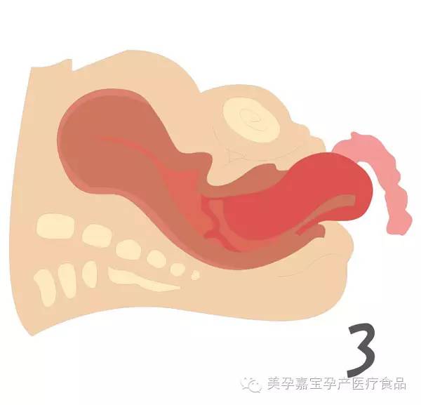 顺产必备神器——"美孕嘉宝"分娩能量包