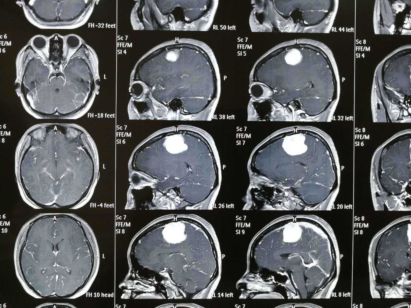 【实例展示】左顶窦镰旁脑膜瘤术后半年复查