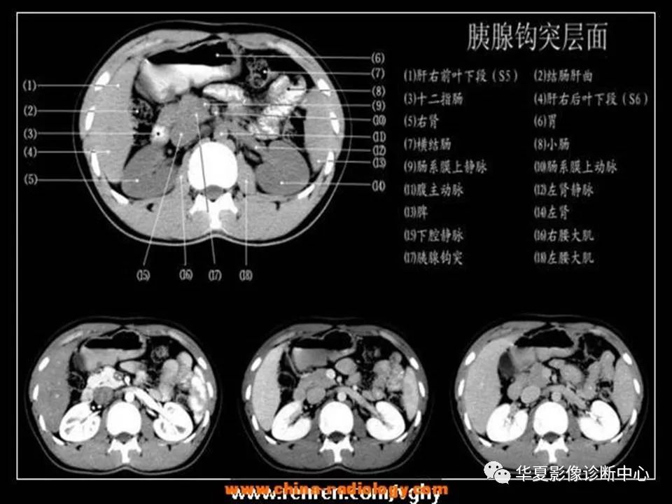 胰腺钩突层面