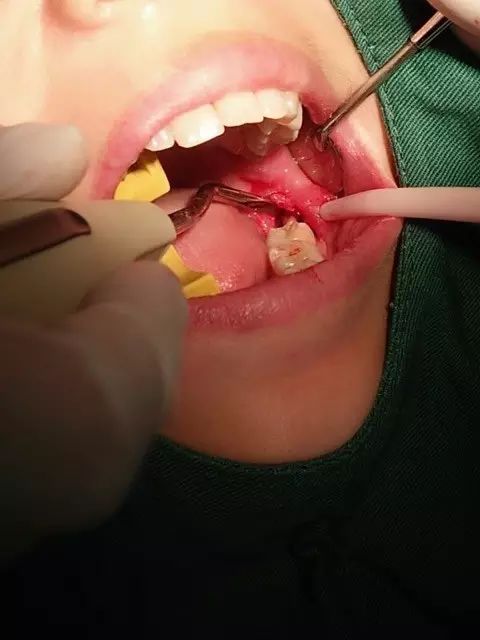 检查发现,拔牙创口一直未愈合,未见明显肿胀,拍片发现,拔牙窝内显示高