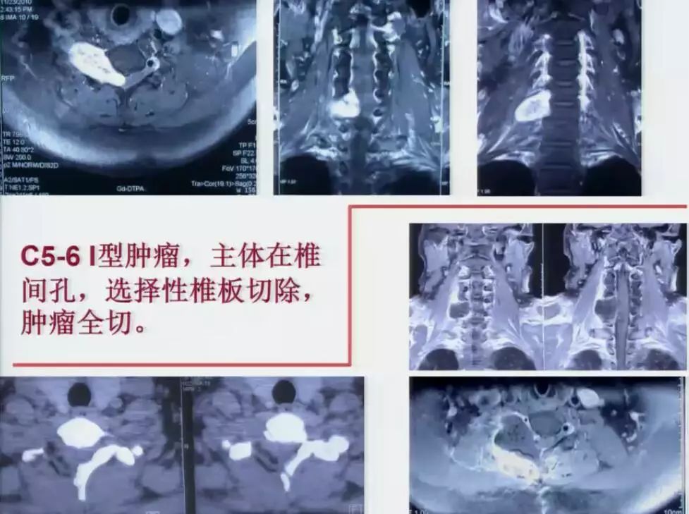 [演讲]北医三院王振宇: 脊髓哑铃型肿瘤5种分型与手术