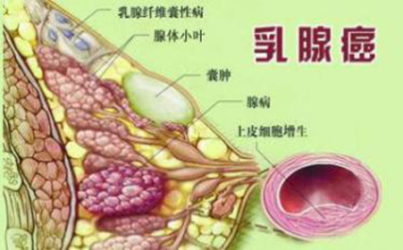 乳腺癌早期症状有5个症状 1,肿块 肿块常为无痛性,单个,不规则,大多为