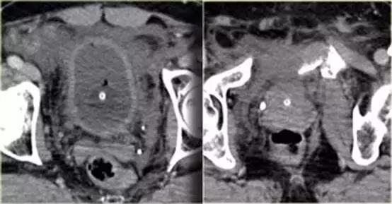 腹腔及膀胱损伤的ct诊断