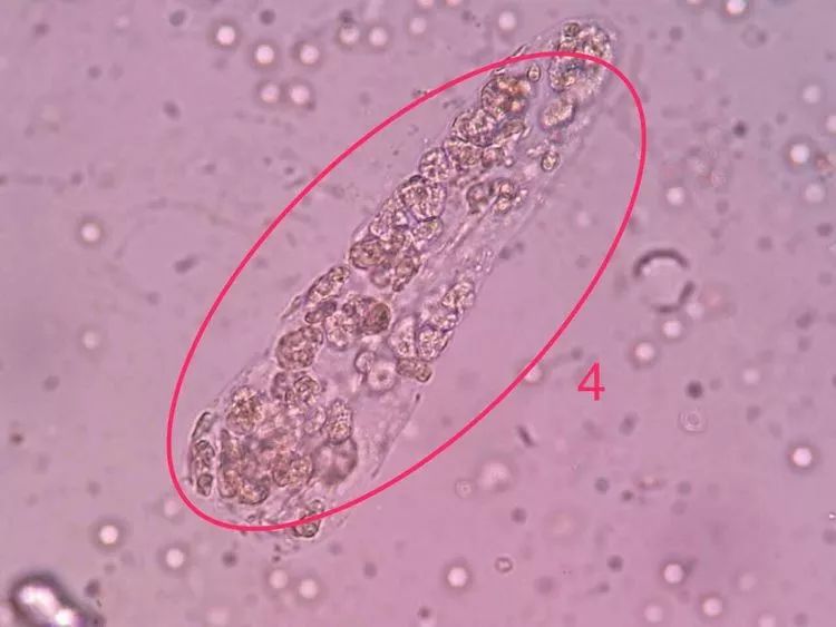尿液管型图片分享细胞图片分享疟原虫专辑