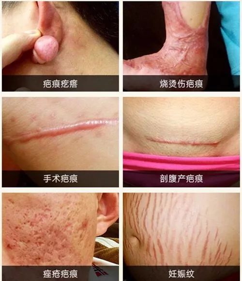 公益杭城丨2017非手术祛疤痕妊娠纹公益诊疗援助活动