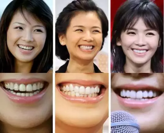 根据小编的经验,目测刘涛的牙齿至少做过三次全口,而且每次的颜色都灰