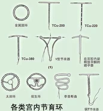 常用的宫内节育器有关闭型的,如不锈钢环;也有开放型的,如呈v字型和t