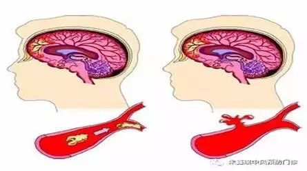 【健康知识】识别中风,这些知识你一定要知道