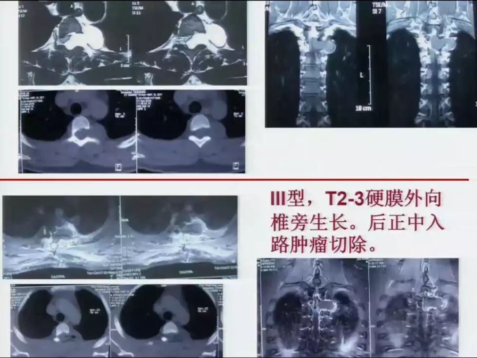 [演讲]北医三院王振宇: 脊髓哑铃型肿瘤5种分型与手术