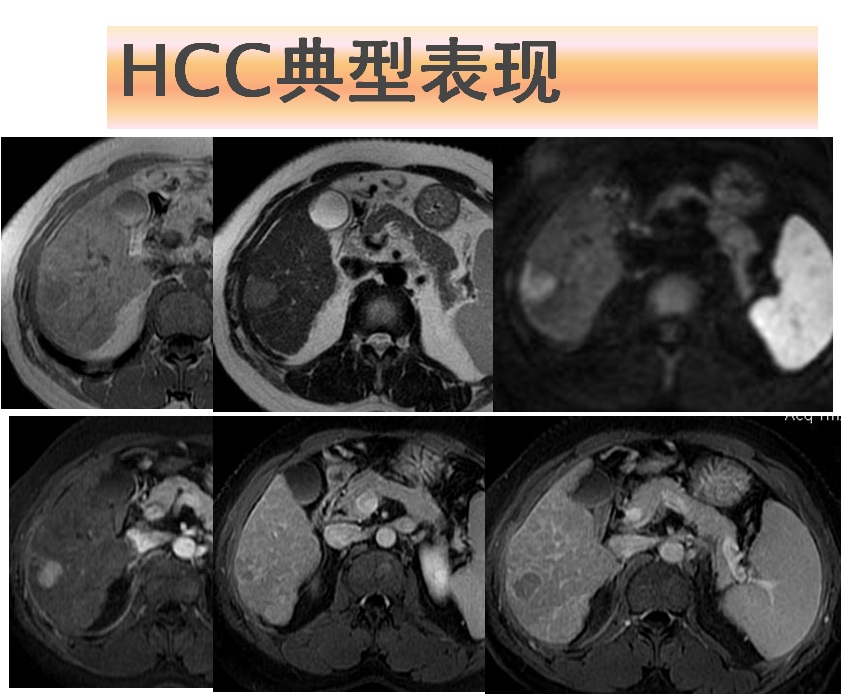 怀疑肝癌了超声ctmripetct怎么使用