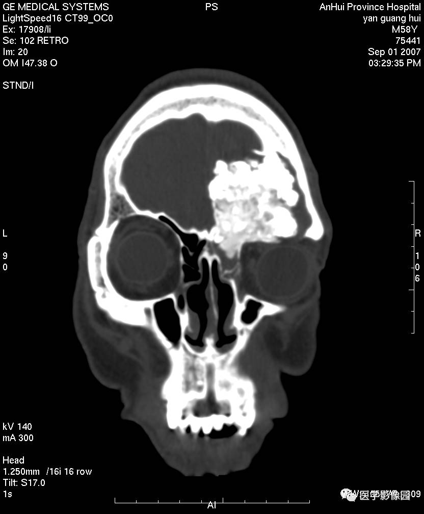 第八章骨骼与软组织第二节骨肿瘤二良性肿瘤四骨化性纤维瘤丨精品连载