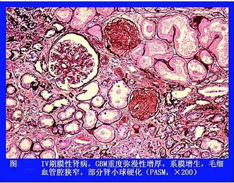 患者科普:你是否知道膜性肾病该怎么治?