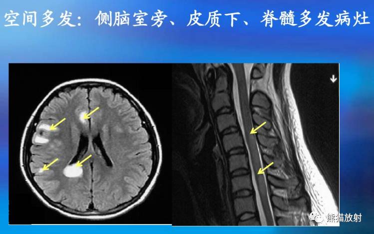 影像病理丨67多发性硬化ms急性播散性脑脊髓炎adem