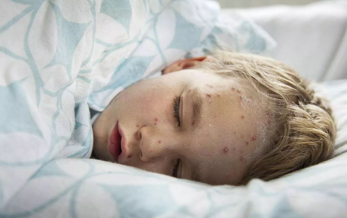 水痘发病时常伴有发热症状,不要让孩子挠抓皮疹,以免引起继发感染.