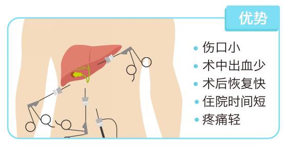 不开膛破肚看腹腔镜下如何做胆囊切除手术