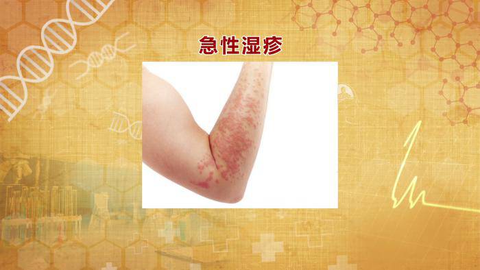 急性湿疹炎症减轻后,皮肤上主要是以小丘疹,结痂和鳞屑为主,丘疱疹及