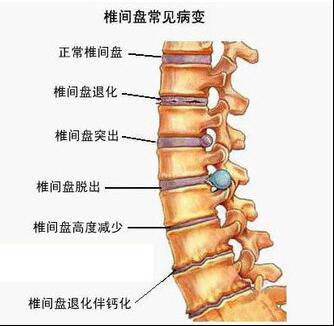 长圆针治疗腰椎间盘突出是什么原理(3)