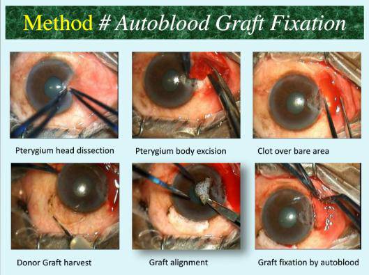翼状胬肉手术,自体结膜移植无需缝线和胶水固定