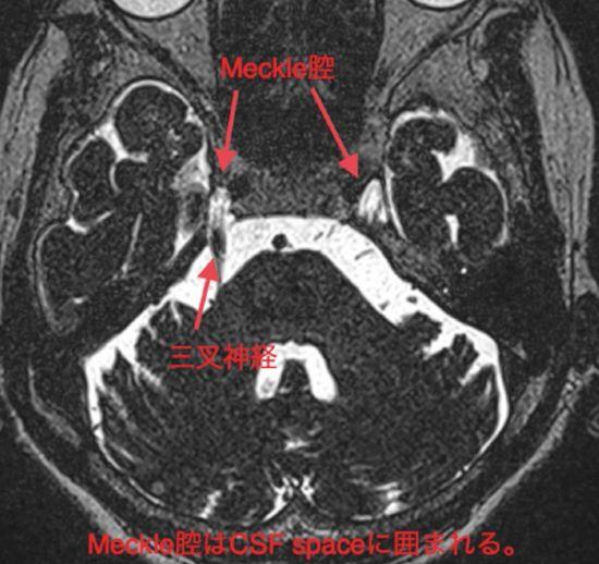 三叉神经meckel腔脑膜瘤
