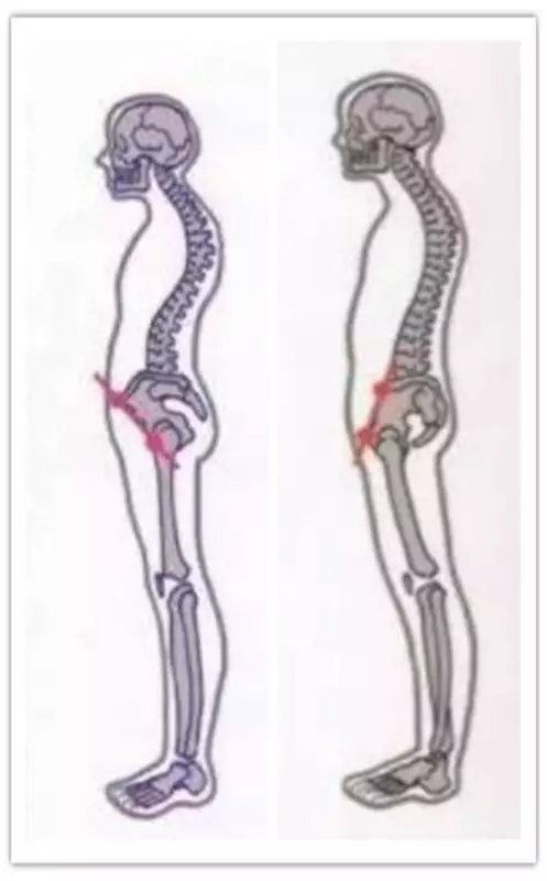 sway back 又称为 懒汉姿势或是摇摆背 ,骨盆前移是指相对于正常人的