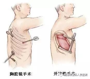 胸腔镜开启手术"微时代" "小切口"考验医生"真功夫"