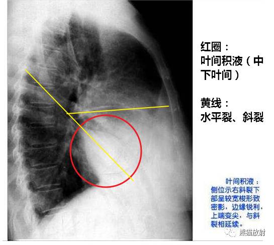 肺底和肺尖局限性积液有何x线表现?