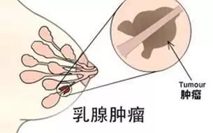 女性乳房有硬块意味着什么?