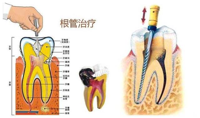 牙齿伤到神经了怎么办