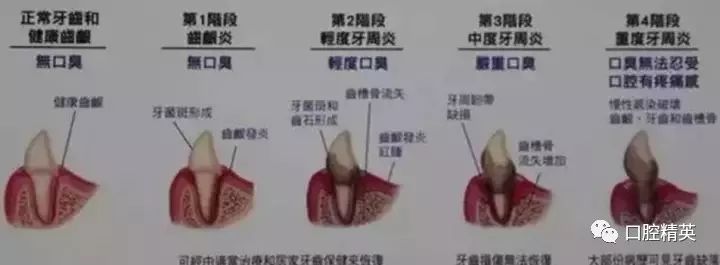牙结石为什么会长在牙龈下面?