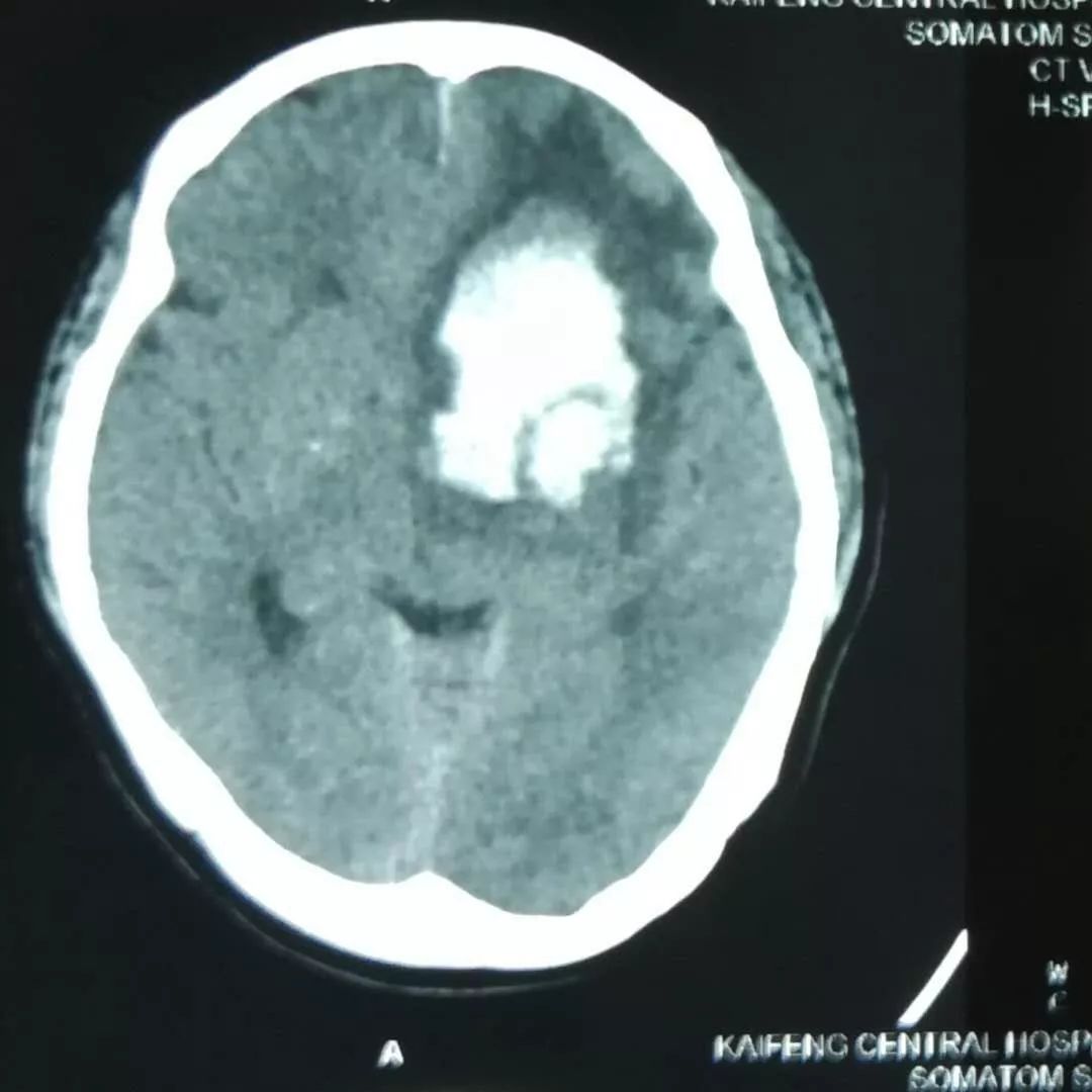 急诊查头颅ct示:左侧基底节区脑出血,出血量约30ml,中线结构向右侧