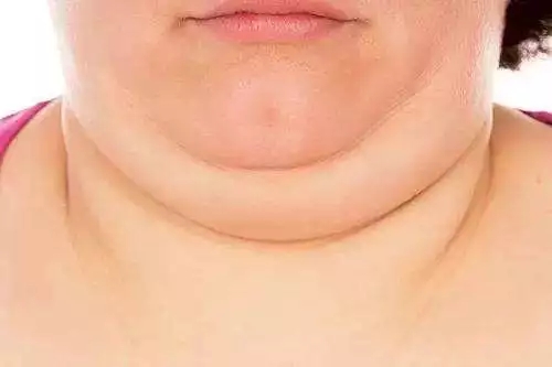 脖子粗的人往往全身整体肥胖,如果还存在气道狭窄,那么患呼吸暂停综合