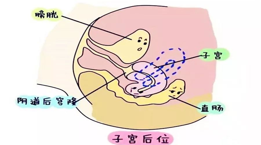 子宫后位——提高受孕率的3个方法