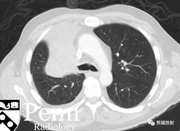 双语病例丨“反s征”与支气管肺癌（x、ct表现） 搜狐大视野 搜狐新闻