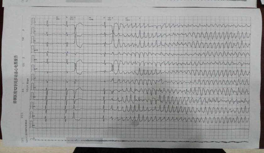 室颤时的心电图