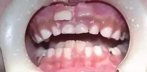 由于旧的乳牙没及时脱落,下牙齿中间长出的两颗新牙,被挤成 "倒八字"