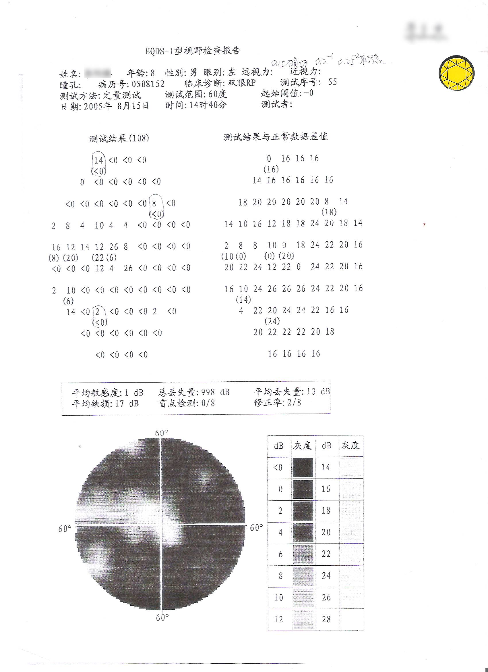 眼科这篇文章为夜盲症视网膜色素变性rp患者开启光明之门