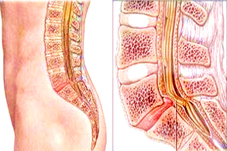 健康 正文  脊柱裂通常分为显性脊柱裂和隐性脊柱裂.