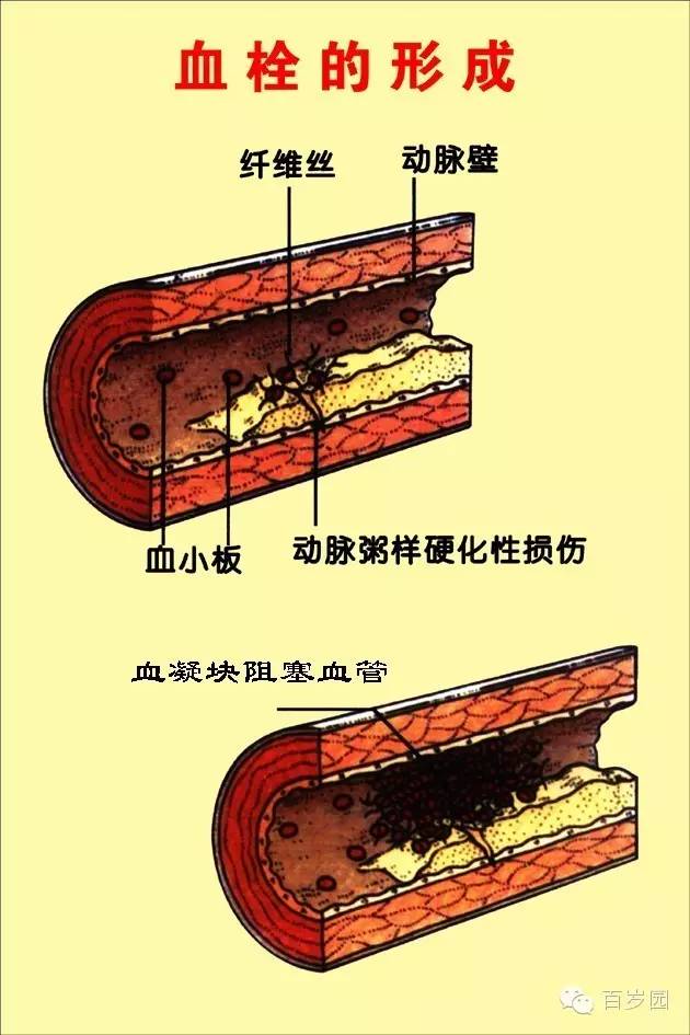 百岁园医学科普之二颈动脉斑块的问题及健康调理干预方法