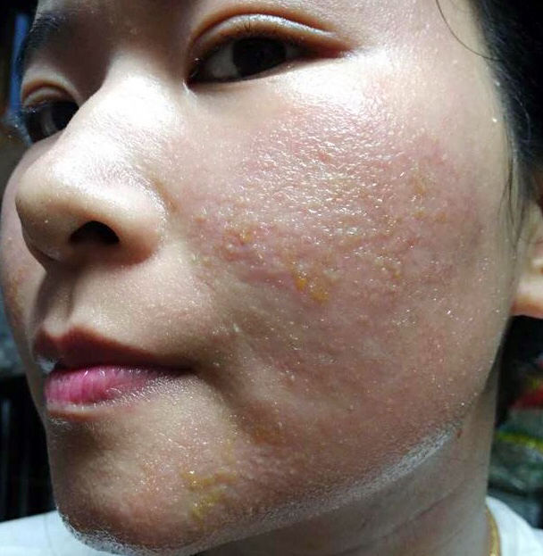 形成面部皮肤范围性细菌感染
