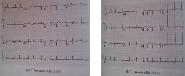 应激性心肌病(tako-tsubo心肌病 典型表现为st段抬高,广泛t波倒置或
