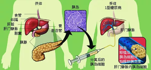 但是,从胰腺把全部100万个胰岛完整提取和纯化几乎是不可能