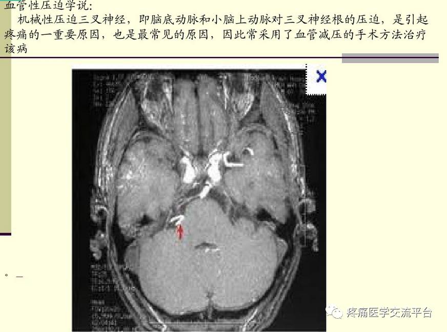 三叉神经解剖及mr表现