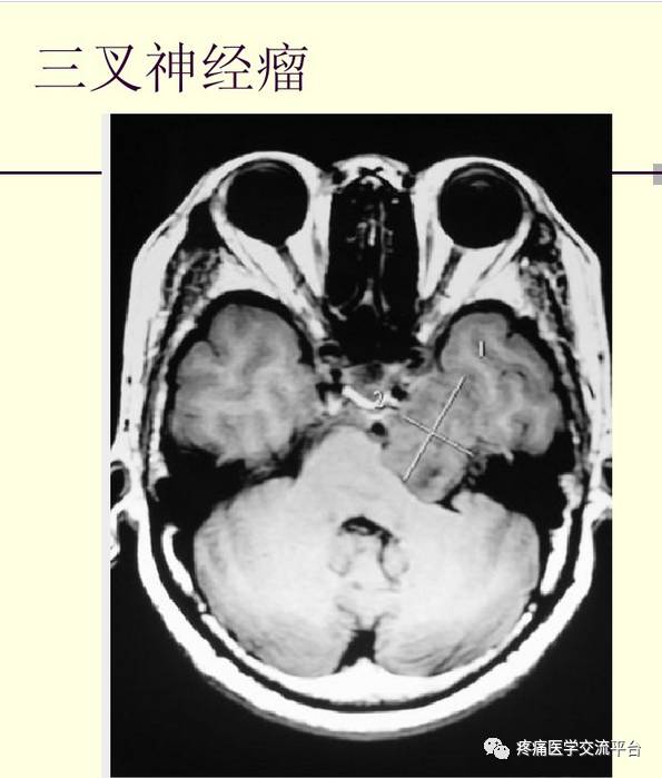 三叉神经解剖及mr表现